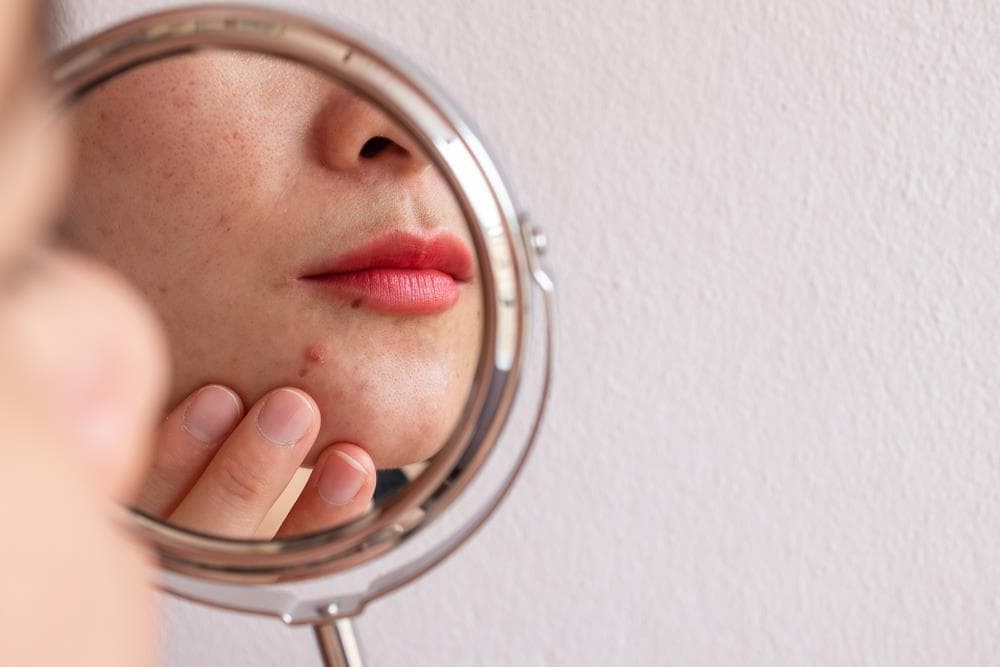 ¿Cómo prevenir y tratar el acné con nuestros tratamientos faciales?